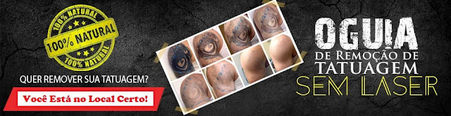 como-remover-tatuagem