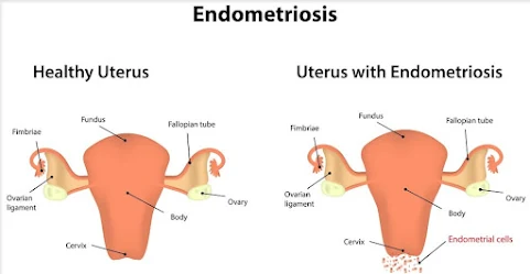 How to Treat Endometriosis Naturally With Herbs