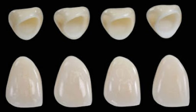 Tìm hiểu sâu hơn về loại răng sứ titan