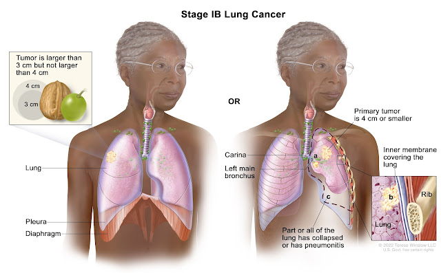 Waa maxay daawaynta ugu fiican ee kansarka sanbabada (Lung Cancer)?