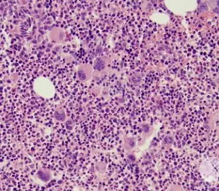 Chronic Myeloproliferative Neoplasms (MPN)-Polycythemia