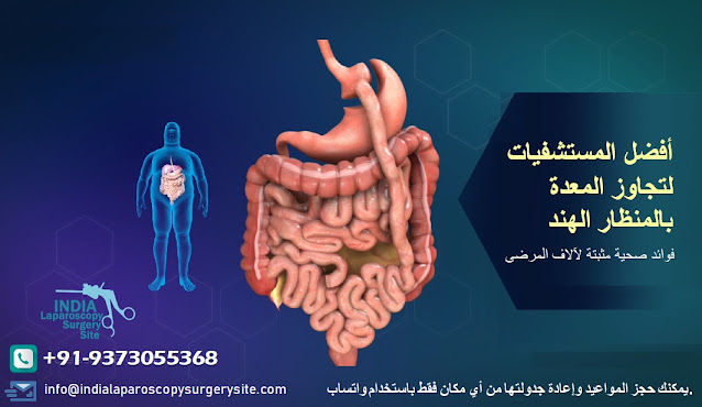 أفضل المستشفيات لتجاوز المعدة بالمنظار الهند