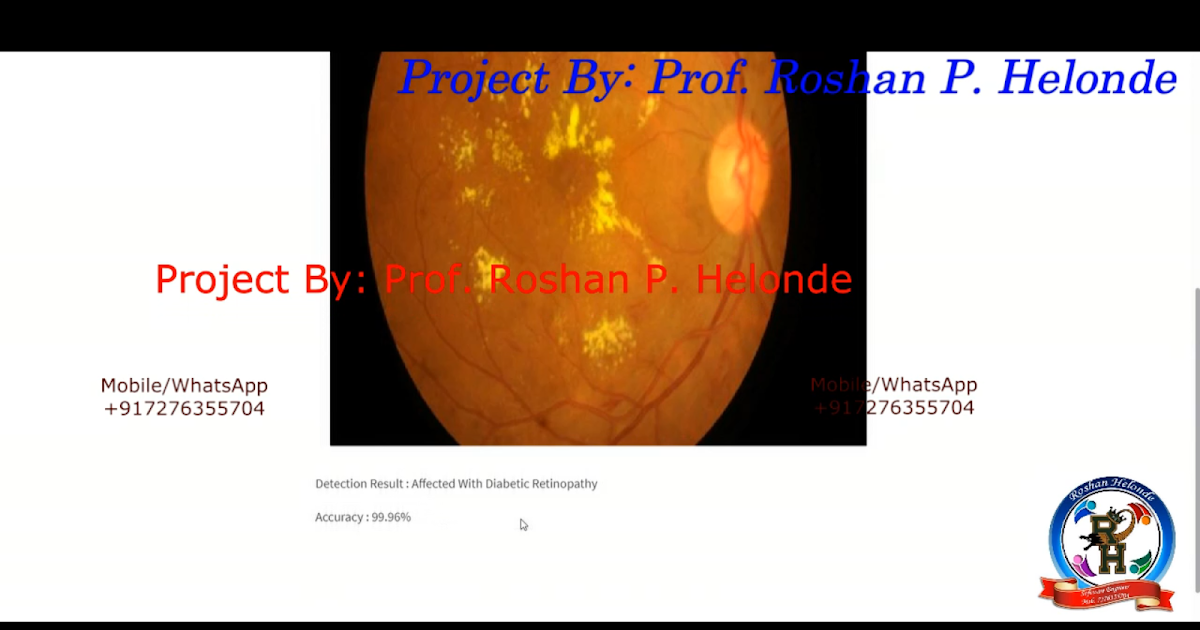 Diabetic Retinopathy Detection Using CNN Convolutional Neural Network ...