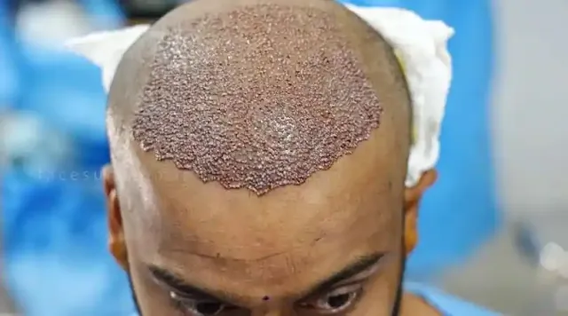 hair transplant kya hai kaise kiya jata hai