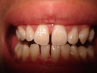 Cách khắc phục tình trạng 2 răng cửa bị thưa