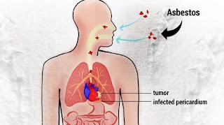 What is pericardial mesothelioma