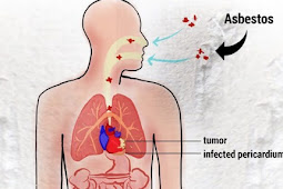 What is pericardial mesothelioma? Pericardial Mesothelioma Resources and Research Information