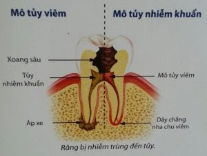 Bọc răng sứ có cần lấy tủy răng không ?