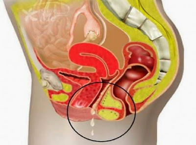 Causes, Symptoms And Treatment Of Urinary Tract Infection