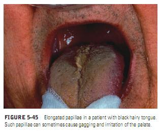 Hairy Tongue (Black Hairy Tongue)