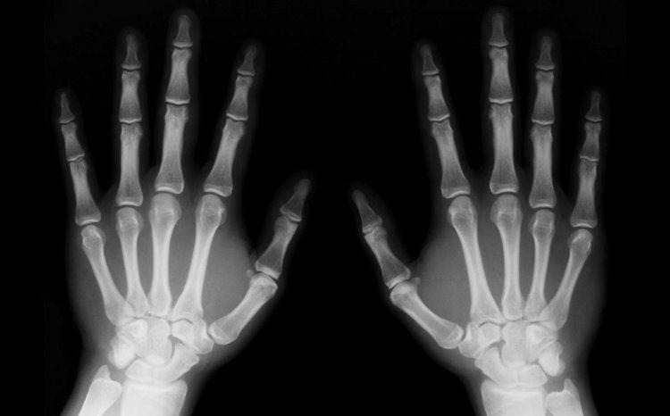 radiografia - Rayos X