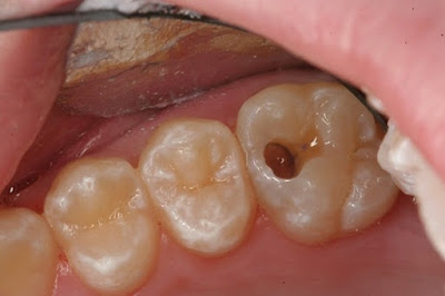 Răng bị lủng lỗ có trám được không?