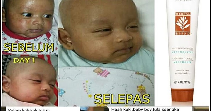 Ubat Untuk Menghilangkan Parut Chicken Pox - Berubat t