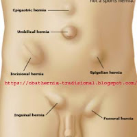 Hernia