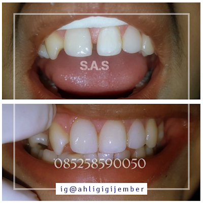 Veneer solusi gigi renggang bercelah dan diastema