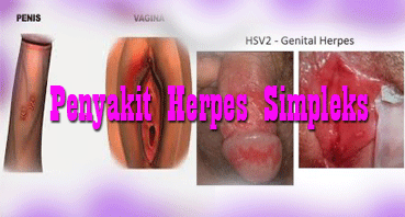 Obat Untuk Penyakit Herpes Simpleks