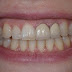 Cách khắc phục chân răng bị vàng an toàn