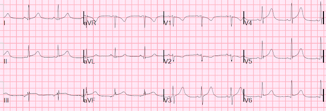 A 30-something with Chest pain, elevated troponin, with Subtle ST Elevation and hyperacute T-waves.