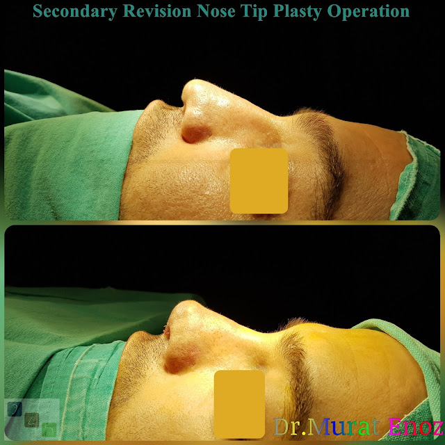 Revision Nose Tip Plasty in Men Istanbul