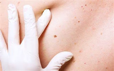 skin cancer : causes, symptoms and prevention - pictures-photos-images