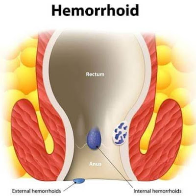 Hemorrhoids and anal fissures
