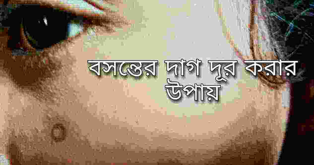 জলবসন্ত বা চিকেন পক্স কি, বসন্তের চিকিৎসা, বসন্ত বা পক্সের দাগ দূর করার উপায়