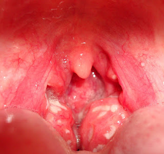 Tonsillitis and its homeopathic treatment
