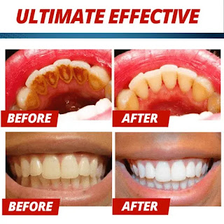 n this article we can learn about In this article, we can know about In this article, we can know about dental, dental hygiene, stain, dental health, teeth stains, dental lab, dental scaler, dental bleaching, dental porcelain, dental staining removal, dental care, dental airflow, dental cleaning too, dental implants, tobacco stain, dental plaque, dental polish stains