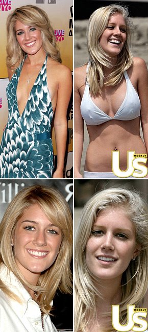 heidi montag surgery before and after. heidi montag after surgery