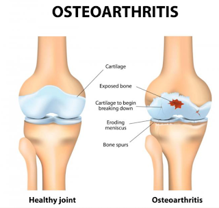 Osteoarthritis treatment in Ayurveda Ernakulam