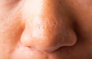 How do I get rid of freckles and acne?
