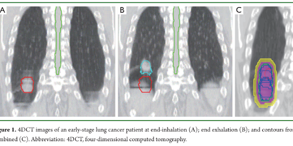 Improving radiotherapy planning, delivery accuracy, and normal tissue sparing using cutting edge technologies