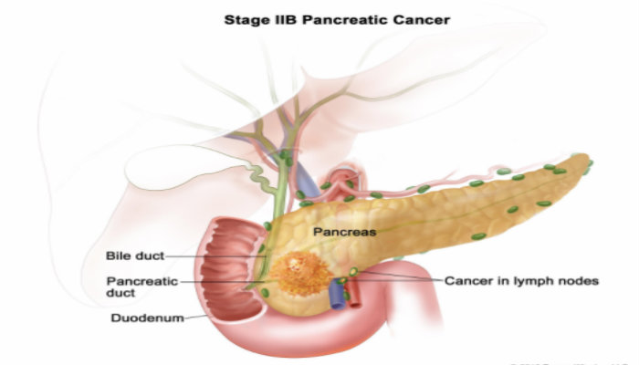 CAUSES, SYMPTOMS, PREVENTION TIPS AND STAGE PANCREATIC CANCER