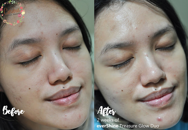 everShine Treasure Glow Duo Before After