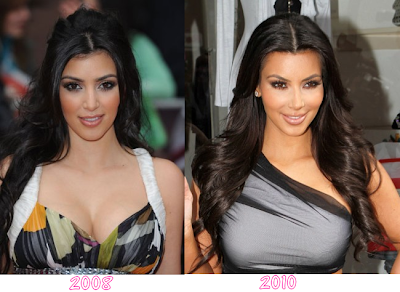 kim kardashian after plastic surgery