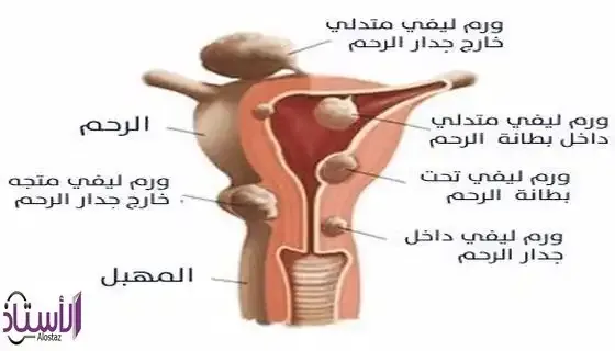 Cases-that-need-surgery-for-uterine-fibroids