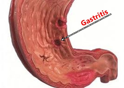 cara mencegah gastritis secara alami