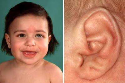 Phát hiện các lỗ nhỏ xung quanh tai