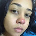 Garota de 20 anos ficou paraplégica por causa de piercing no nariz 
