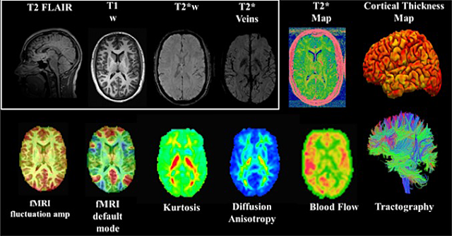 CARE MRI integrating multimodal imaging biomarkers of changes in brain structure and function. Mild traumatic brain injury, or concussion, is a major issue of concern in the military, as well as within the sports community. The NCAA-DoD Grand Alliance CARE Consortium works to better understand sports-related concussions among varsity athletes including students at the four Military Service Academies. (Image courtesy of NCBI)