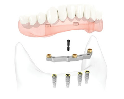 Giá cấy ghép implant bao nhiêu?