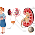 Kidney Stone Ayurvedic Treatment And Medicine