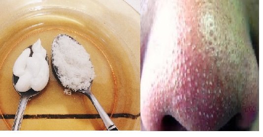 Tips Ampuh Bersihkan Komedo Dalam Sekejap Dengan Pasta Gigi dan Garam!! Begini Caranya..