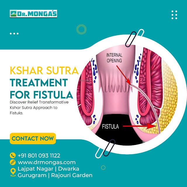 Kshar Sutra Treatment for Fistulas