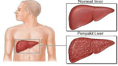 Penyakit Liver