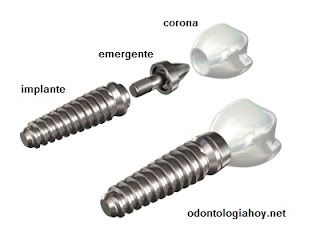 implante dental emergente y corona dental