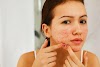 how to get rid of pimples and get rid of acne permanently for glowing skin 