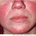 Acne (and Rosacea) Link to MRSA