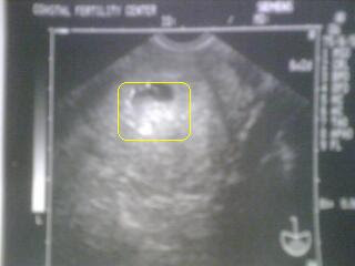 WE HAVE A HEARTBEAT!!!!!!