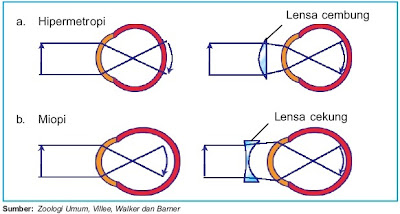 Cacat mata pada manusia hipermetropi dan miopi